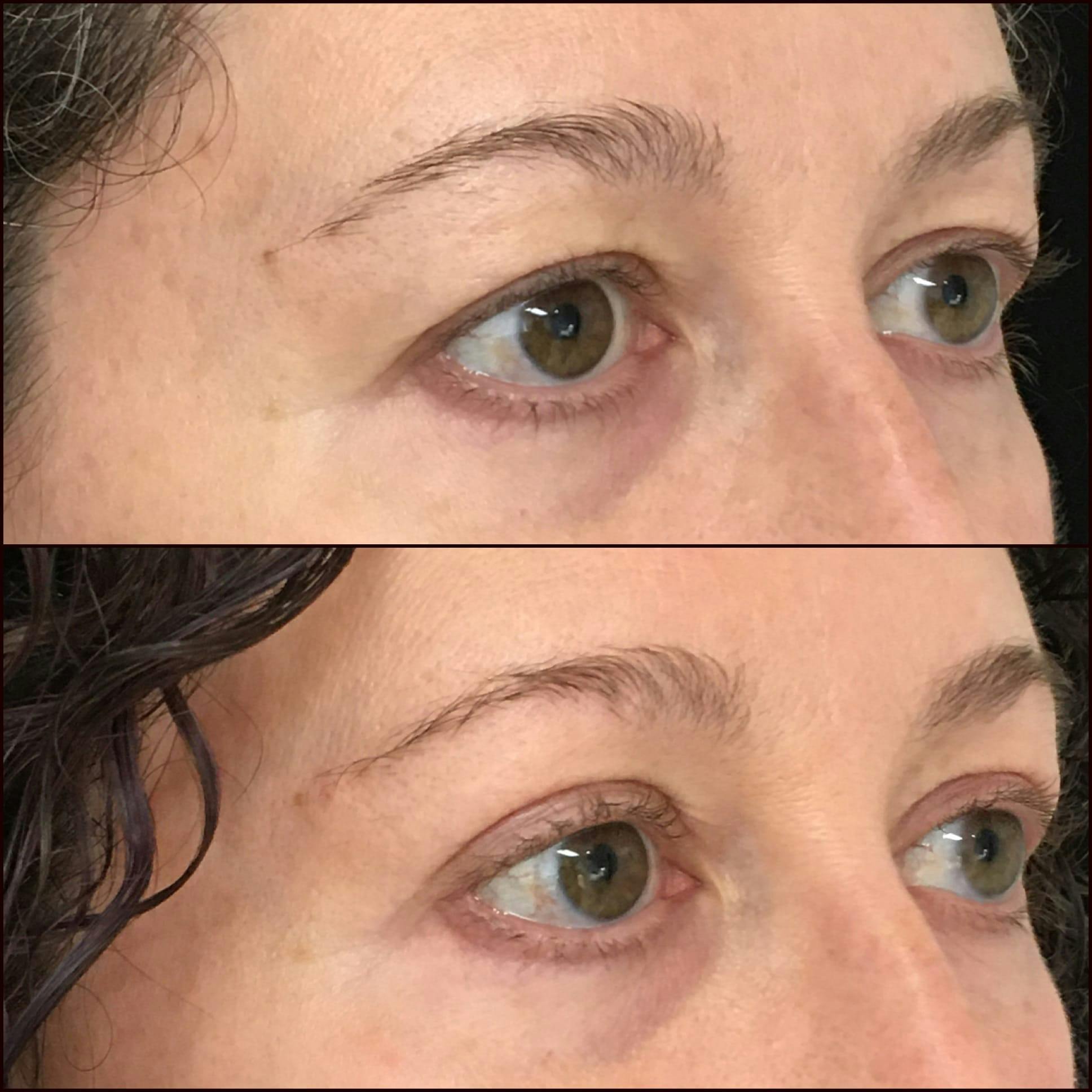 Upper Blepharoplasty Before & After Gallery - Patient 53591719 - Image 2