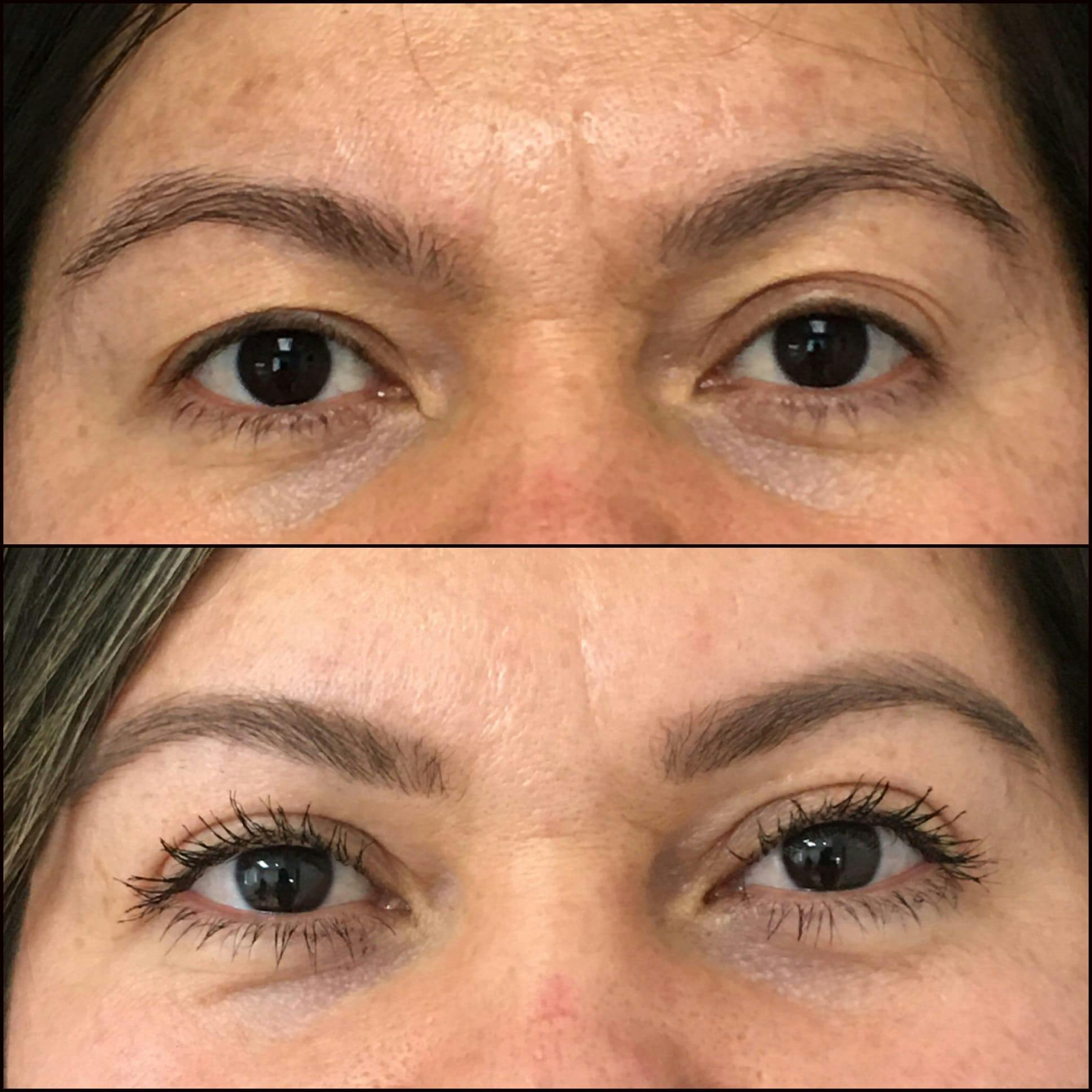 Upper Blepharoplasty Before & After Gallery - Patient 53591721 - Image 1