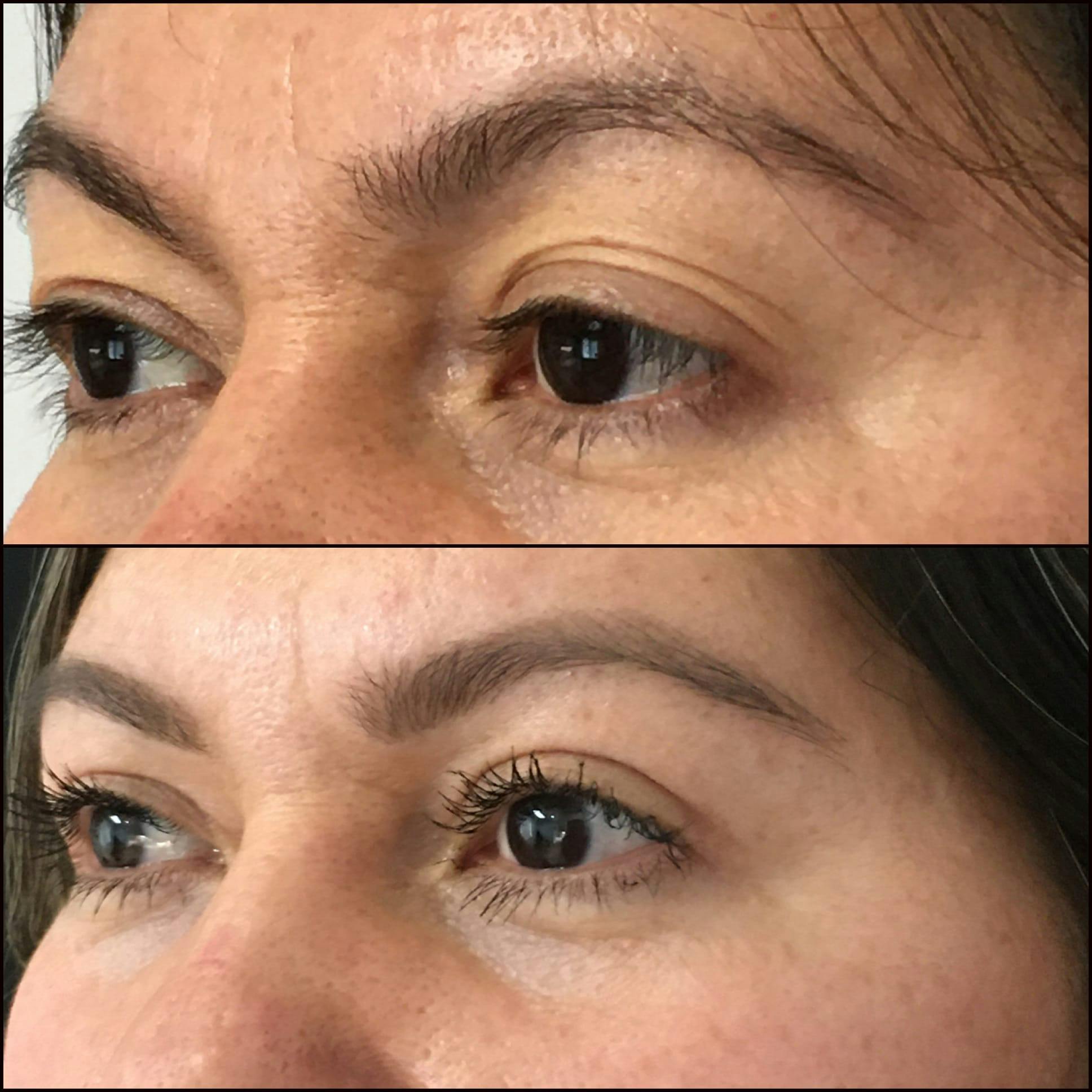 Upper Blepharoplasty Before & After Gallery - Patient 53591721 - Image 2