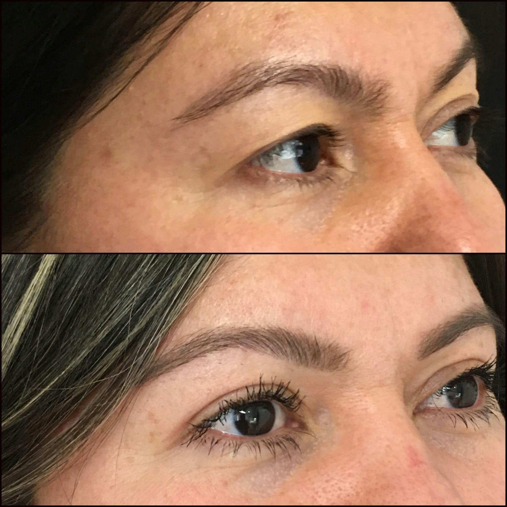 Upper Blepharoplasty Before & After Gallery - Patient 53591721 - Image 3