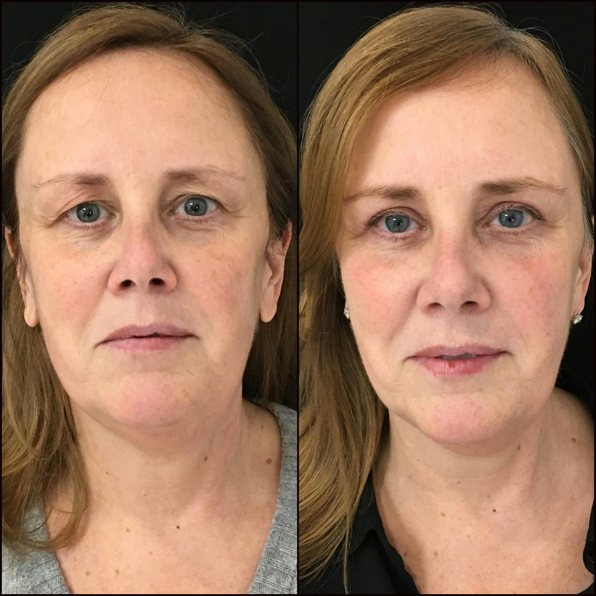 Upper Blepharoplasty Before & After Gallery - Patient 53591723 - Image 2