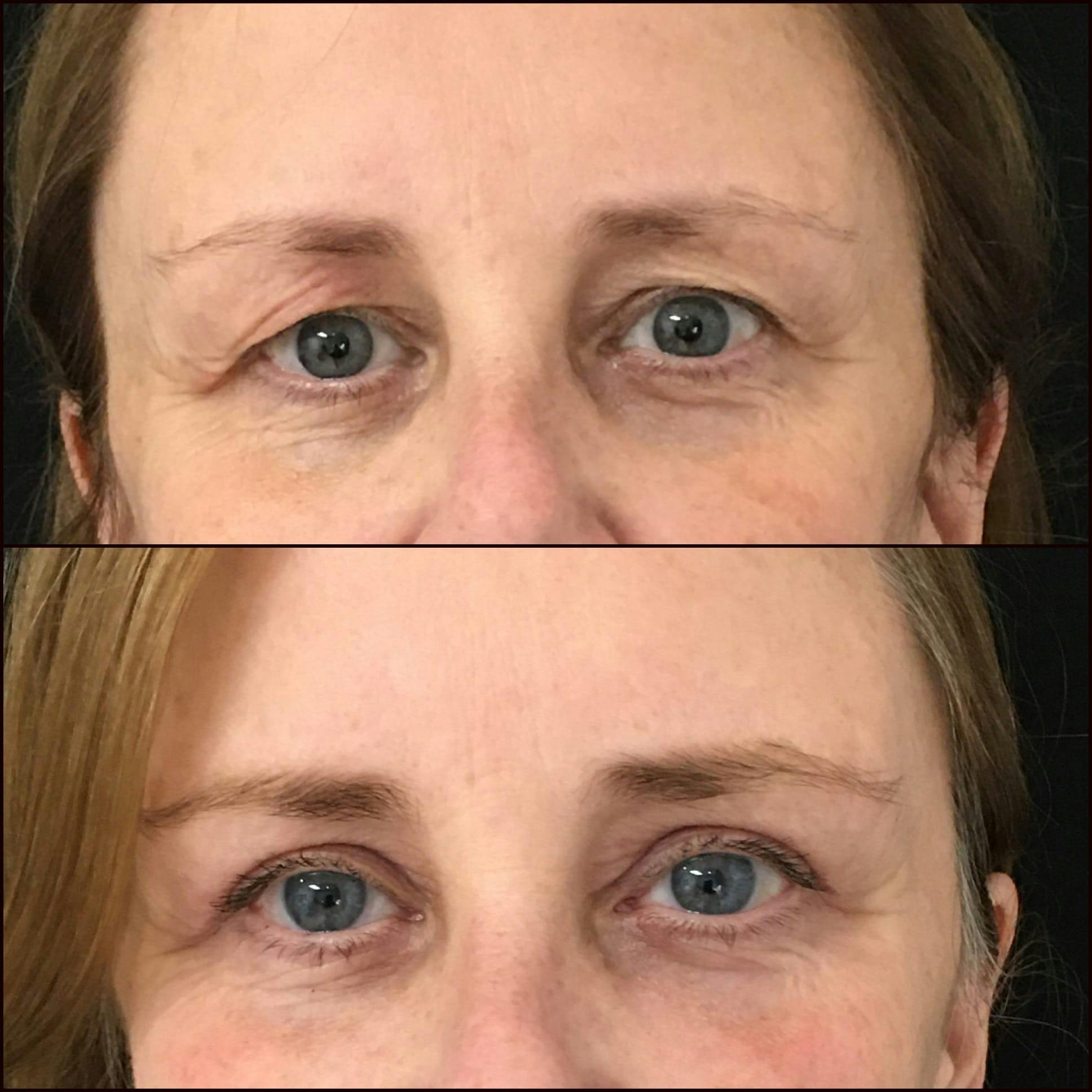 Upper Blepharoplasty Before & After Gallery - Patient 53591723 - Image 1