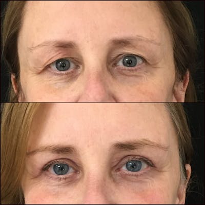 Upper Blepharoplasty Before & After Gallery - Patient 53591723 - Image 1