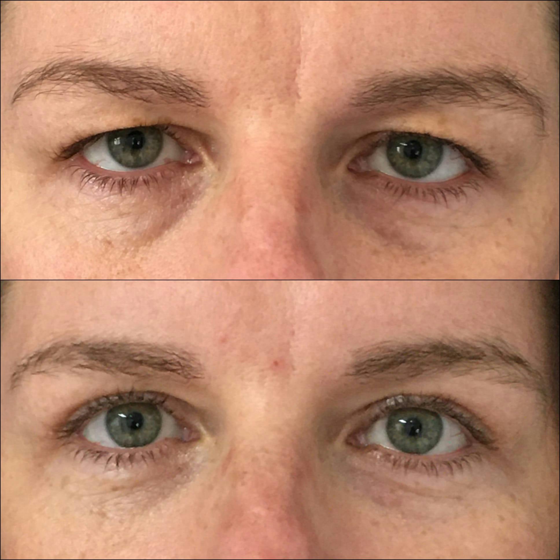 Upper Blepharoplasty Before & After Gallery - Patient 53591727 - Image 1