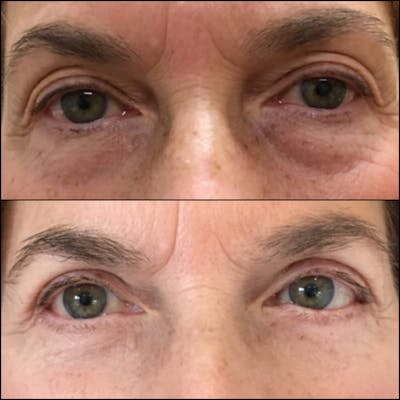 Upper Blepharoplasty Before & After Gallery - Patient 54039136 - Image 1