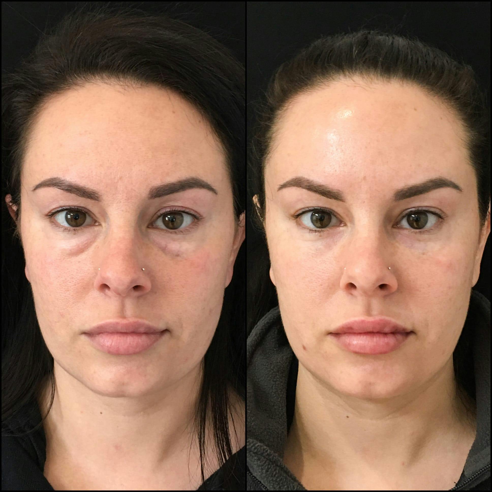 Lower Blepharoplasty Before & After Gallery - Patient 53591861 - Image 1