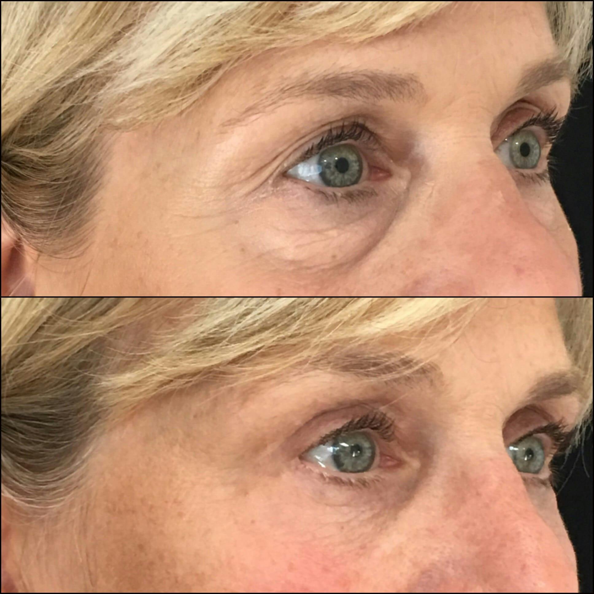 Lower Blepharoplasty Before & After Gallery - Patient 53591862 - Image 1