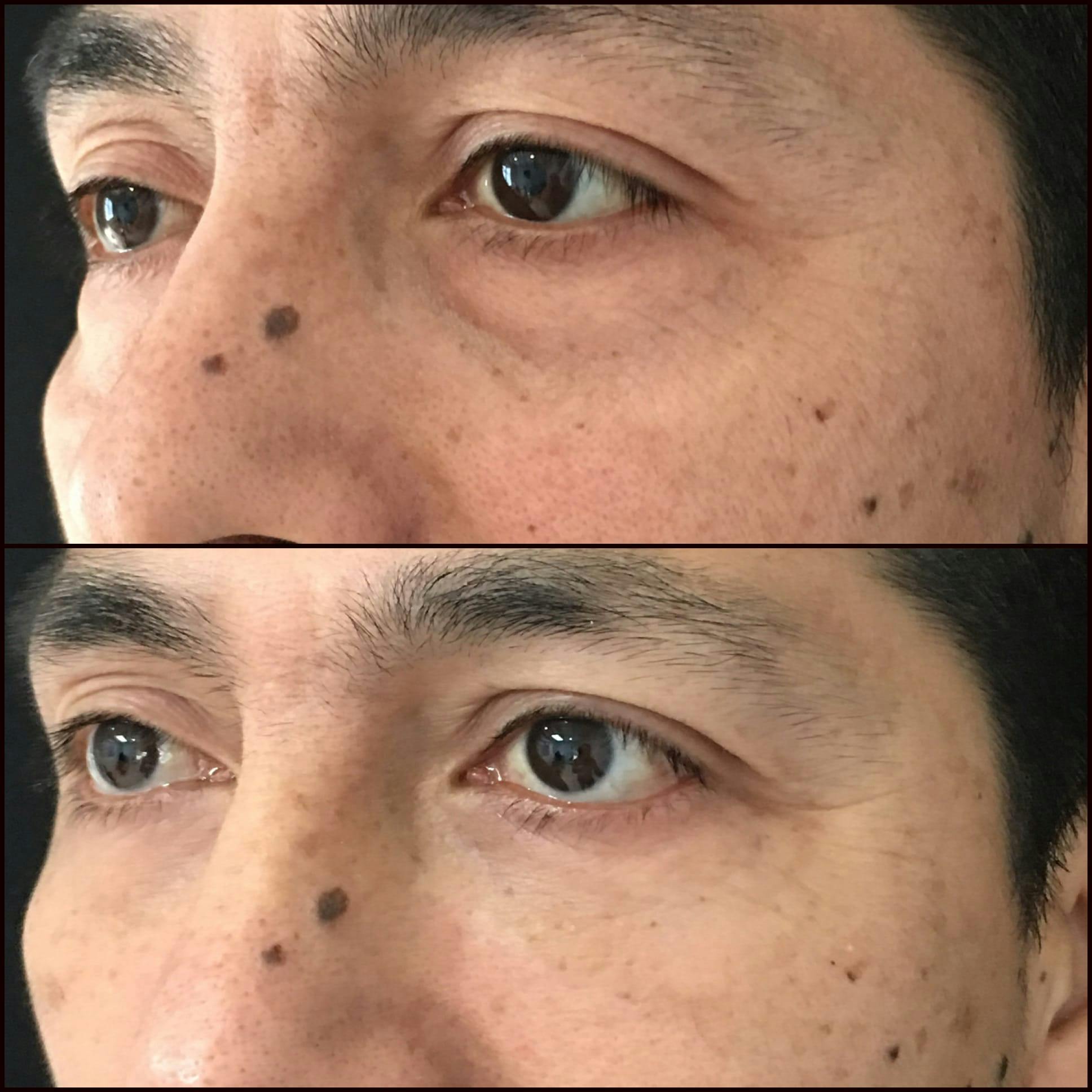 Lower Blepharoplasty Before & After Gallery - Patient 53591863 - Image 1