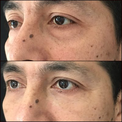 Lower Blepharoplasty Before & After Gallery - Patient 53591863 - Image 1