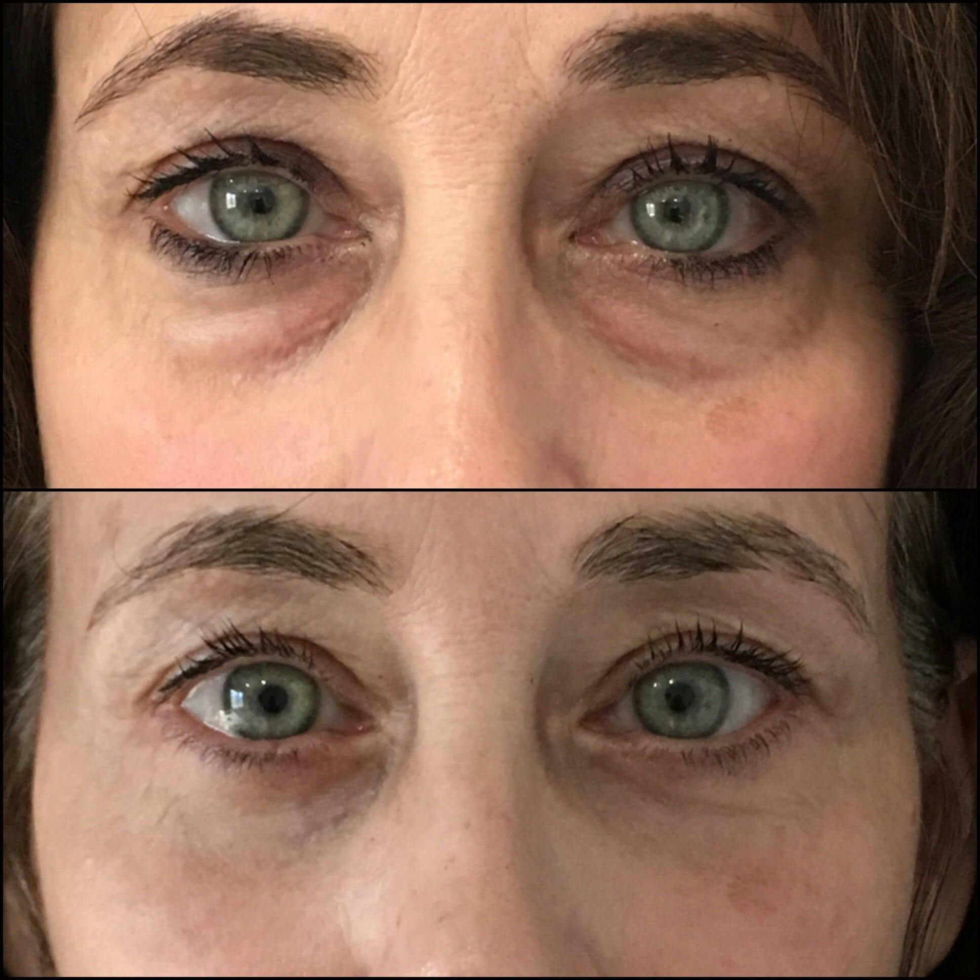Lower Blepharoplasty Before & After Gallery - Patient 53591864 - Image 1