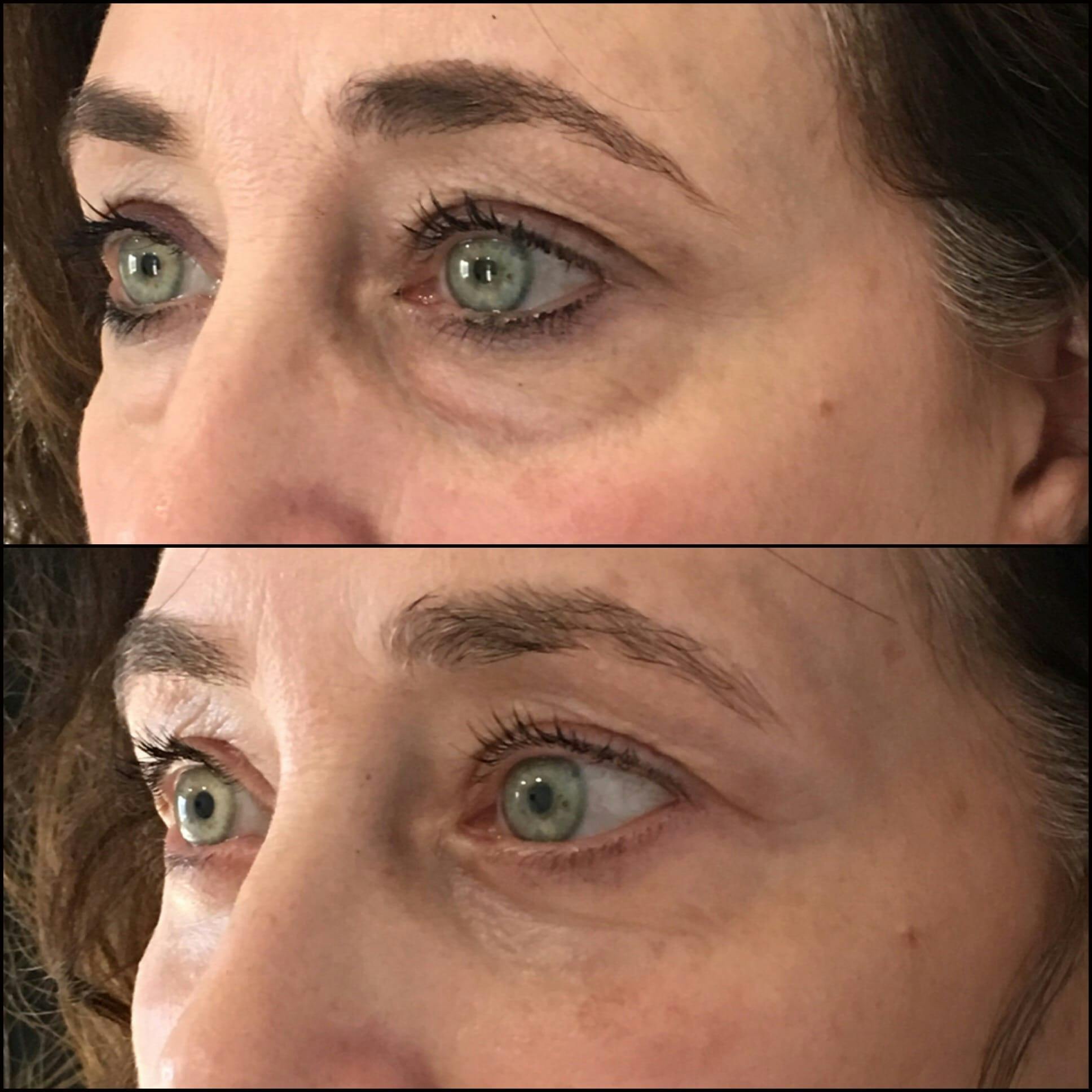 Lower Blepharoplasty Before & After Gallery - Patient 53591864 - Image 2