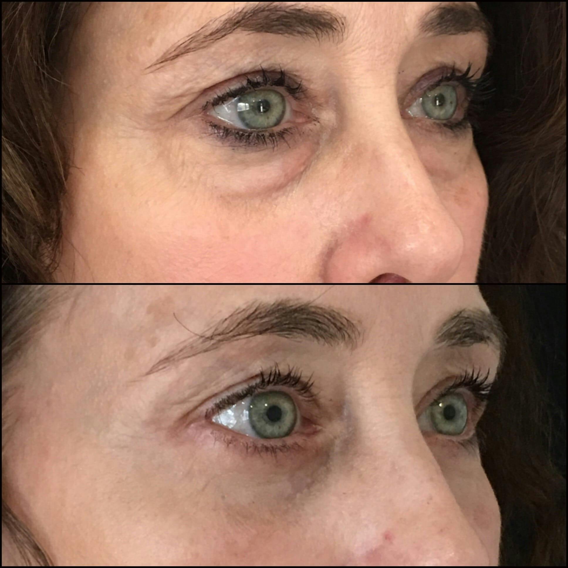 Lower Blepharoplasty Gallery - Patient 53591864 - Image 3
