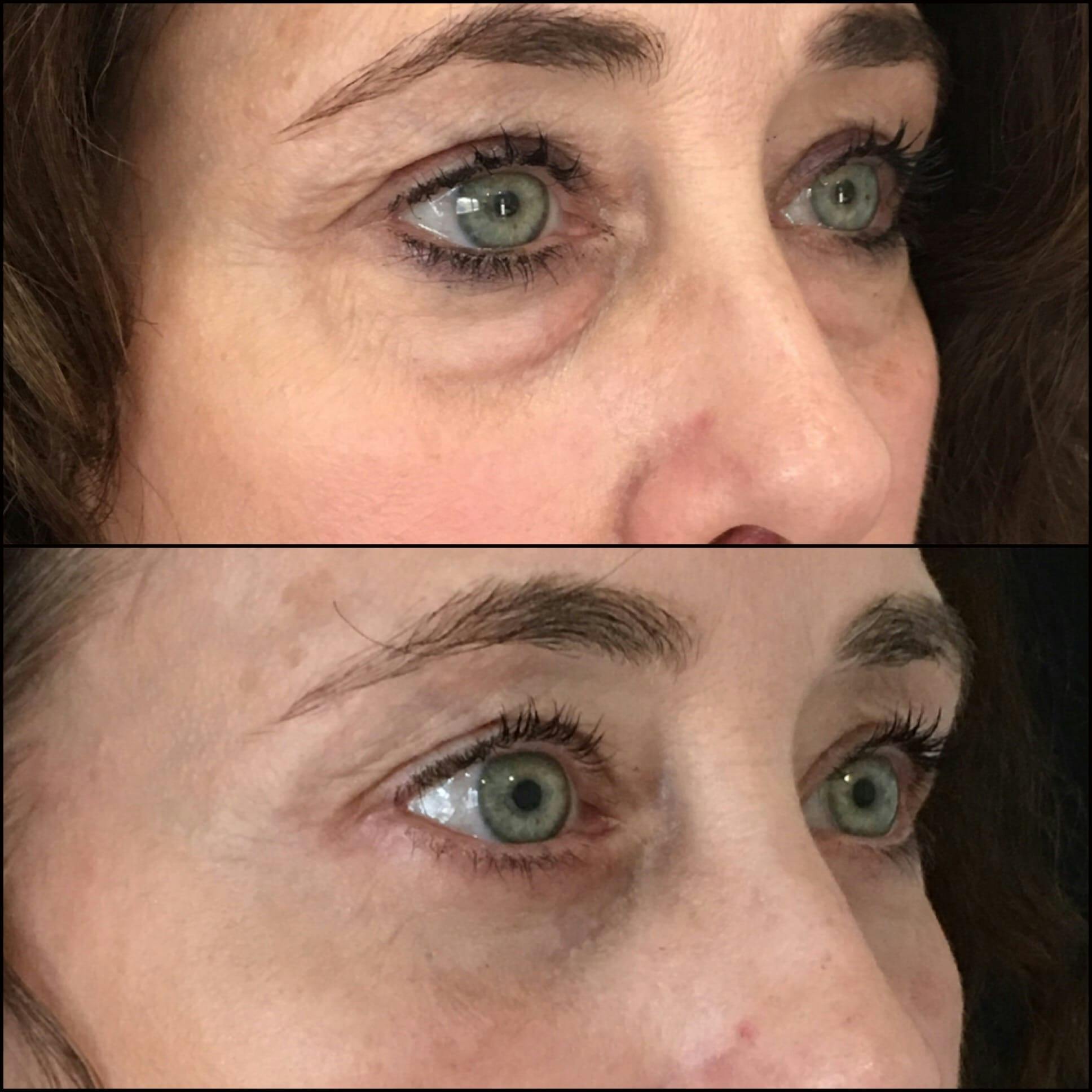 Lower Blepharoplasty Before & After Gallery - Patient 53591864 - Image 3