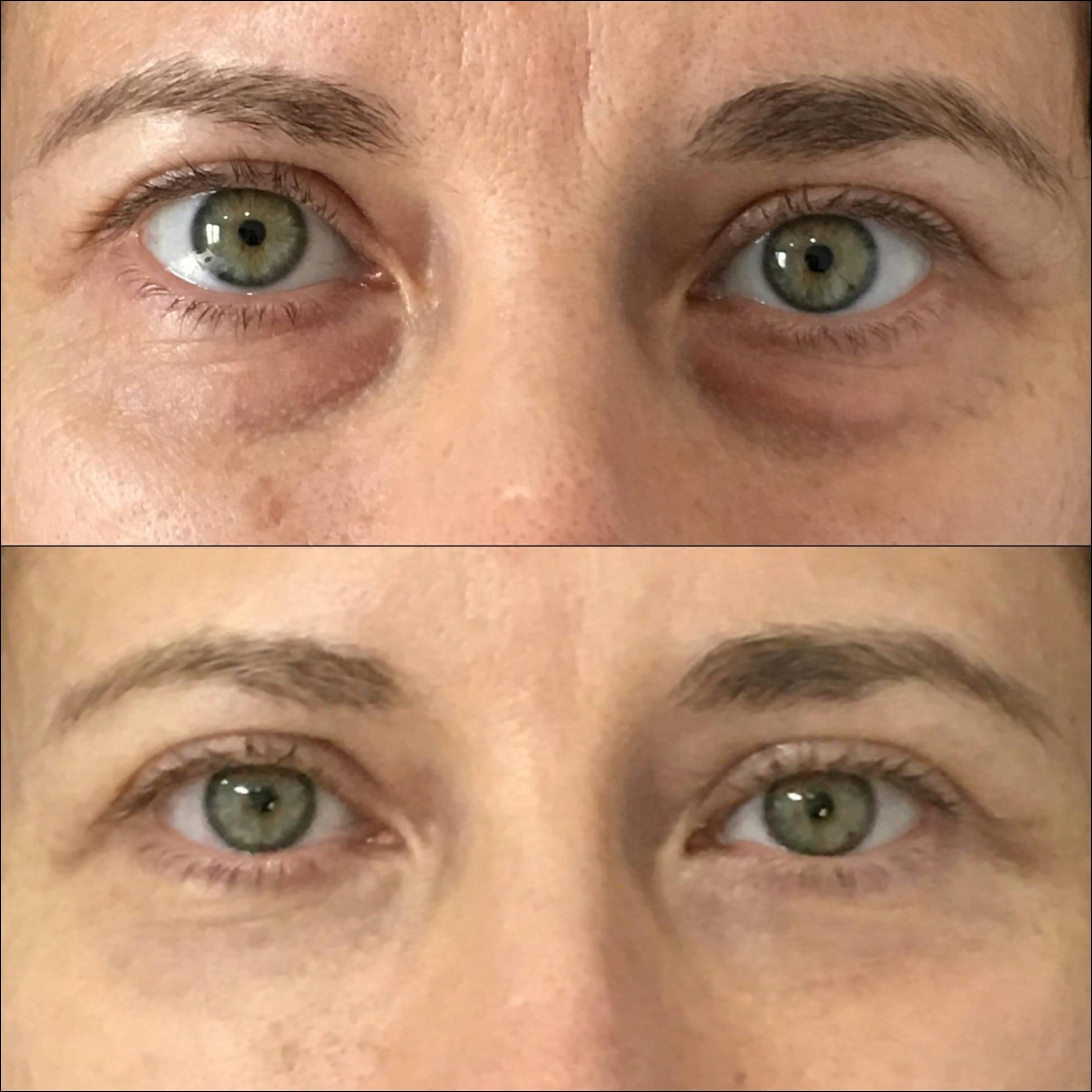 Lower Blepharoplasty Before & After Gallery - Patient 53591865 - Image 1