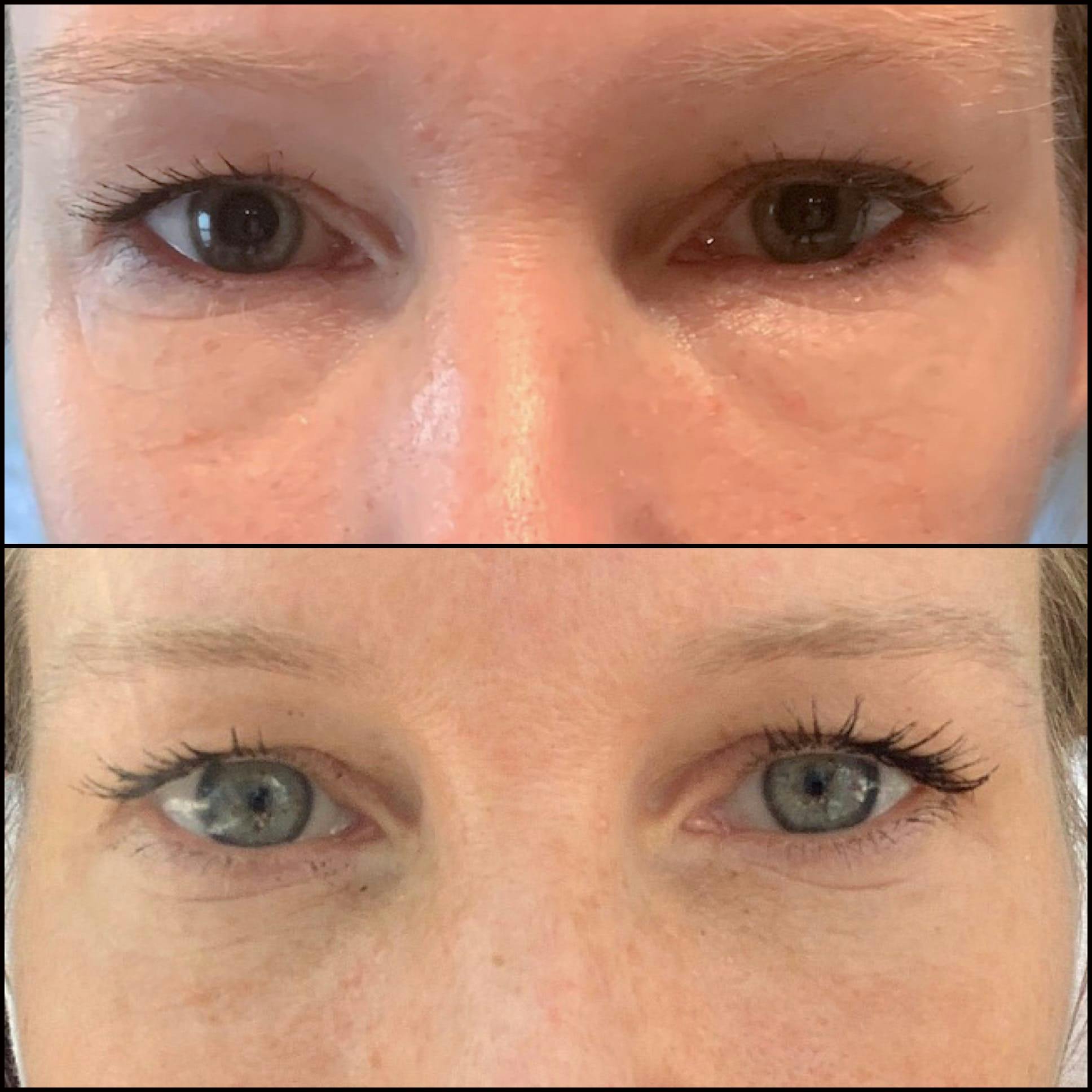 Lower Blepharoplasty Before & After Gallery - Patient 53591868 - Image 1