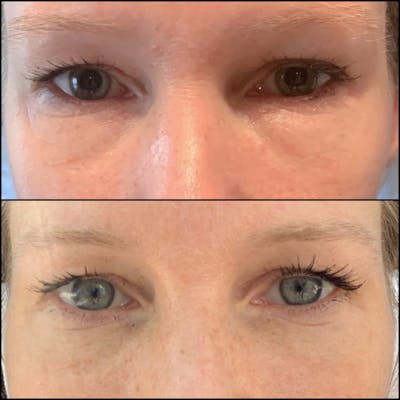 Lower Blepharoplasty Before & After Gallery - Patient 53591868 - Image 1