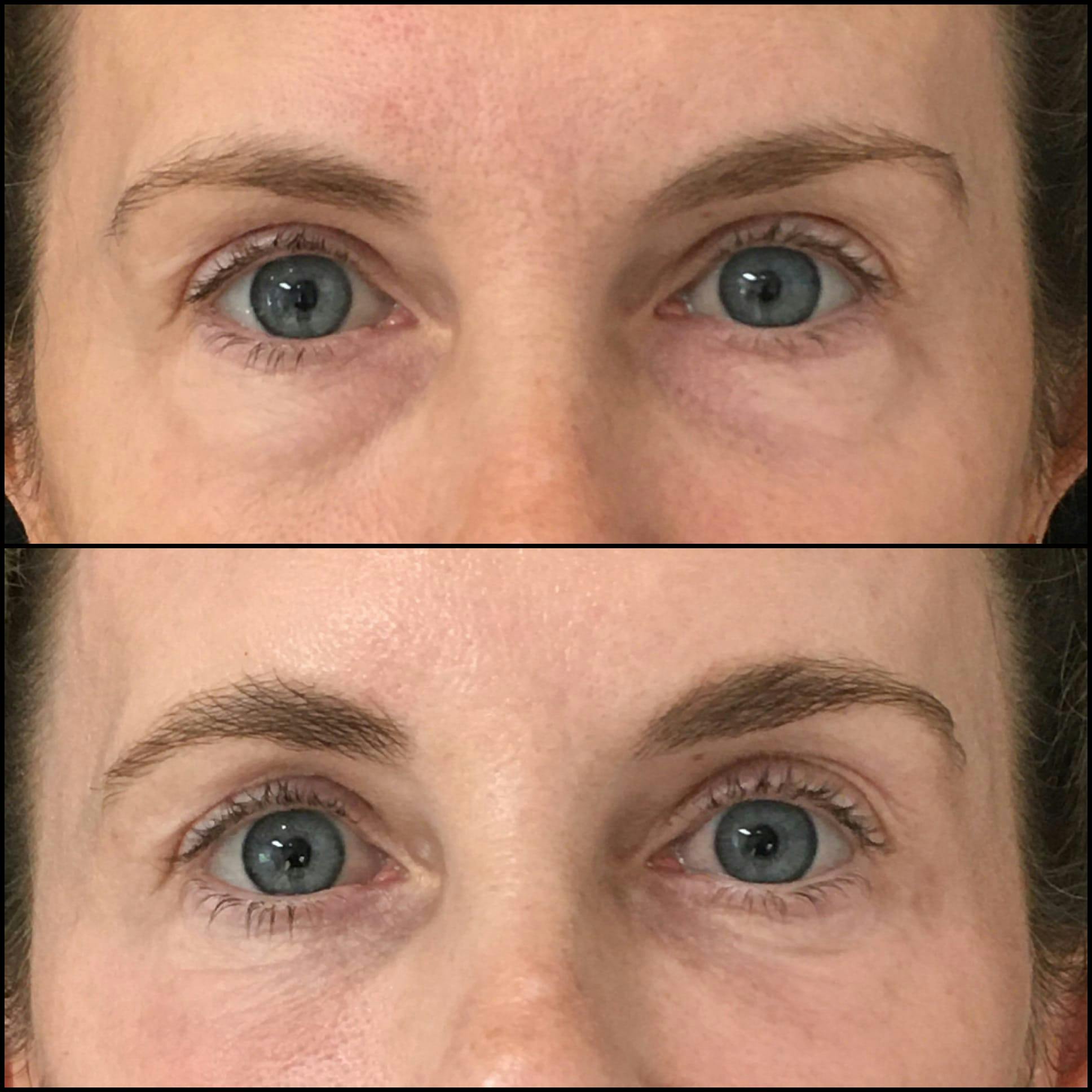 Lower Blepharoplasty Before & After Gallery - Patient 53591870 - Image 1