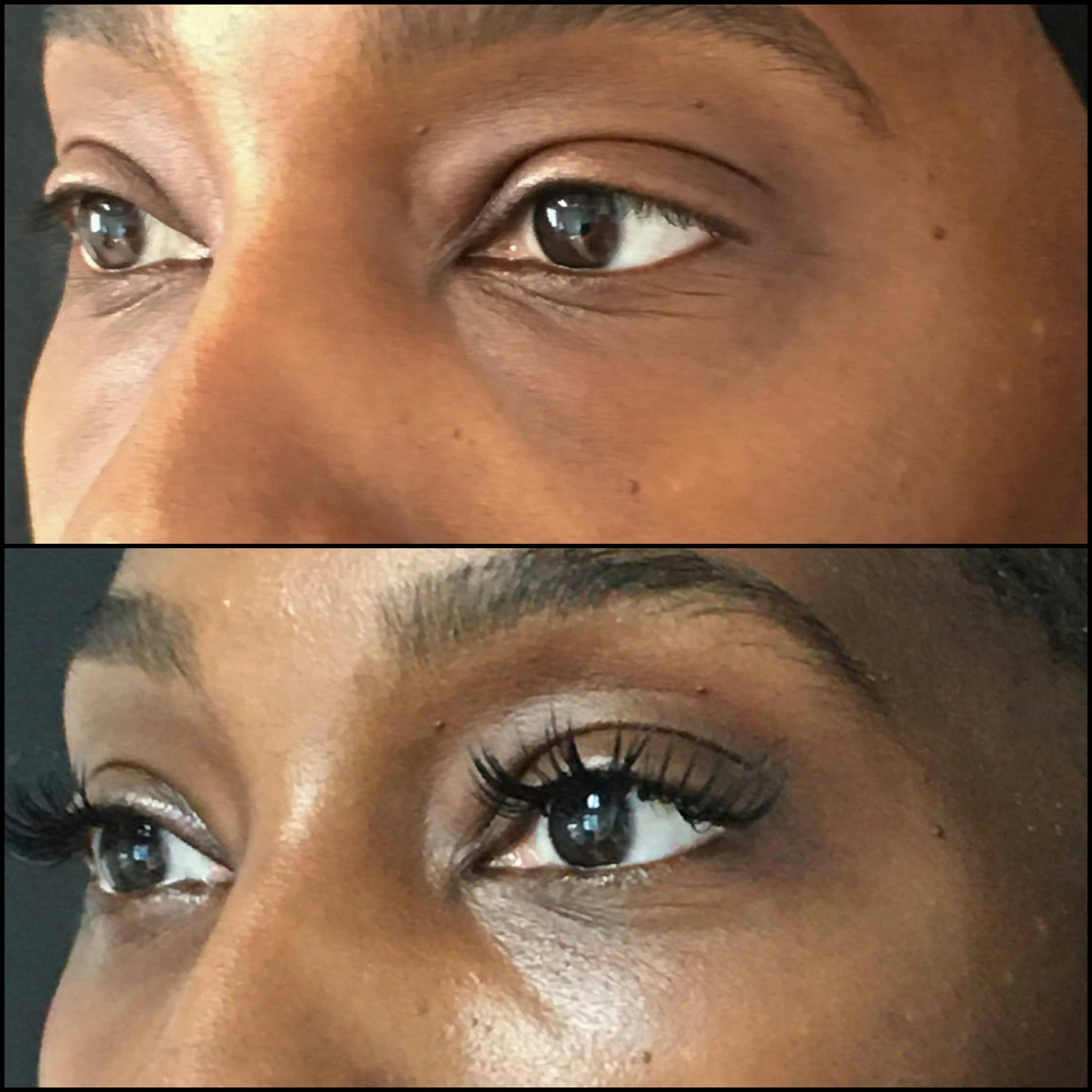 Lower Blepharoplasty Before & After Gallery - Patient 53591871 - Image 2