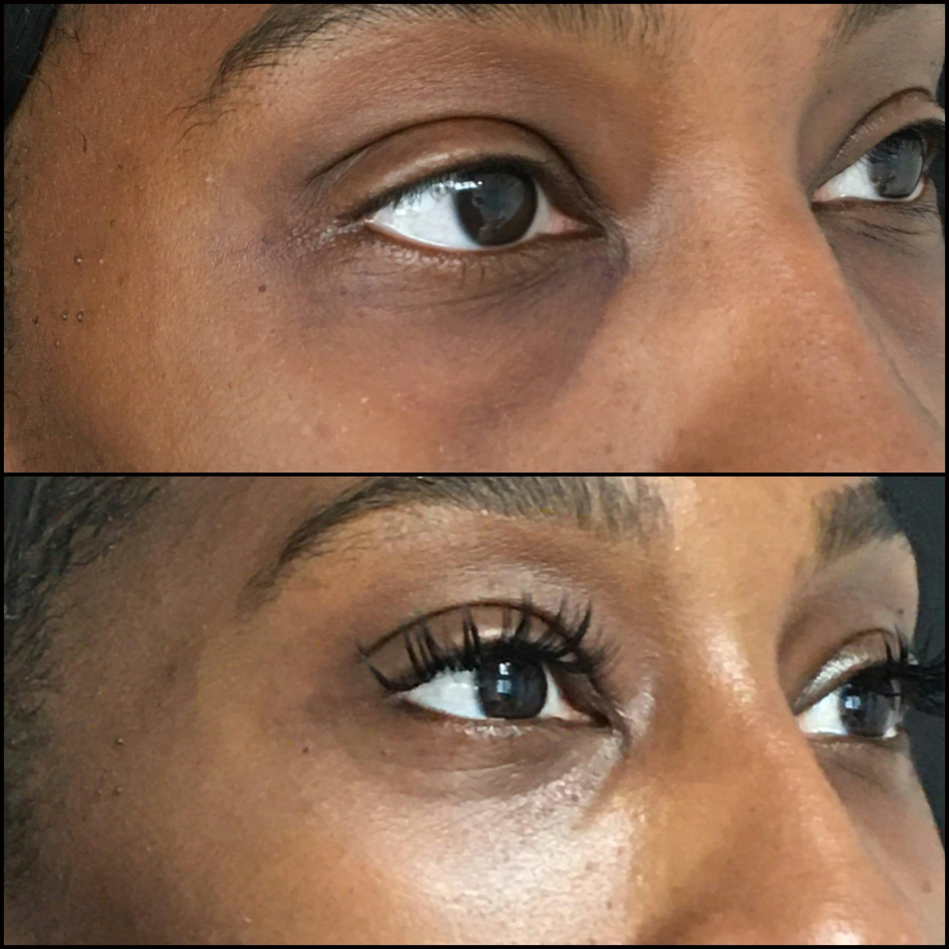 Lower Blepharoplasty