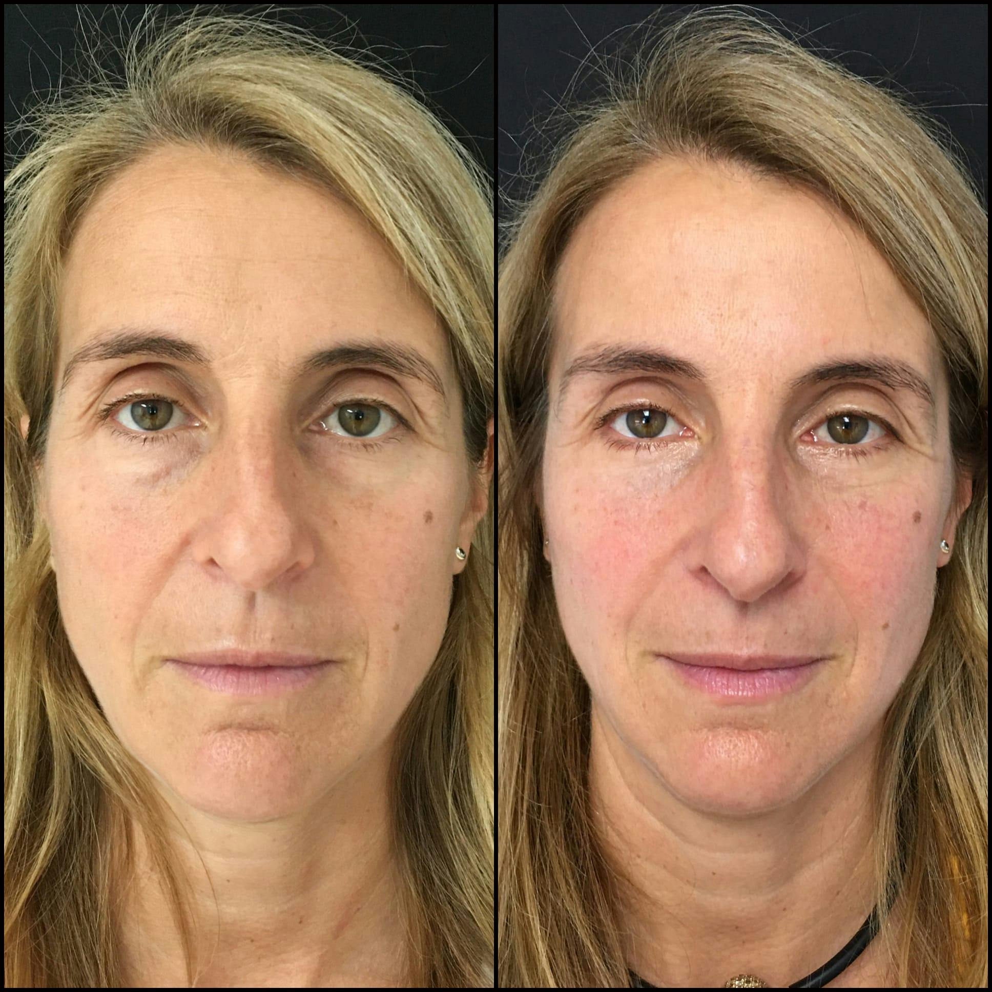 Lower Blepharoplasty Before & After Gallery - Patient 53591875 - Image 1