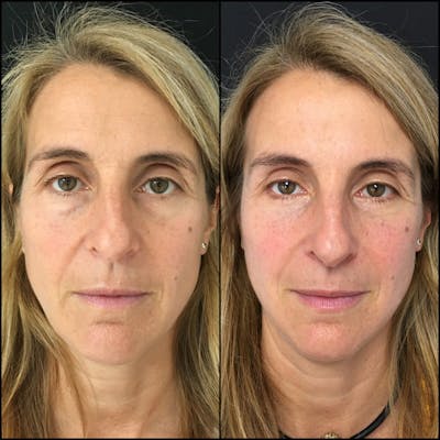 Lower Blepharoplasty Before & After Gallery - Patient 53591875 - Image 1