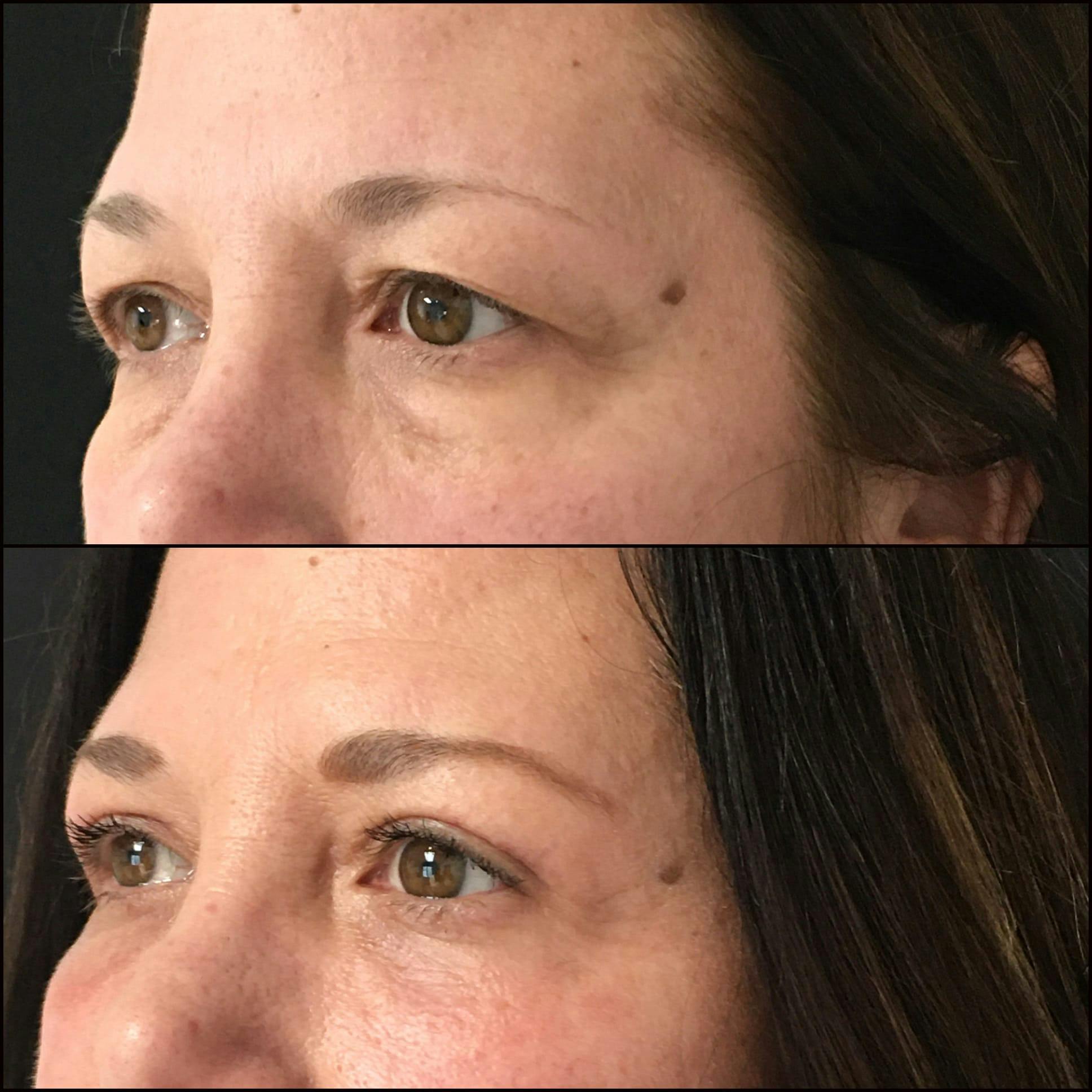Lower Blepharoplasty Before & After Gallery - Patient 53591874 - Image 2