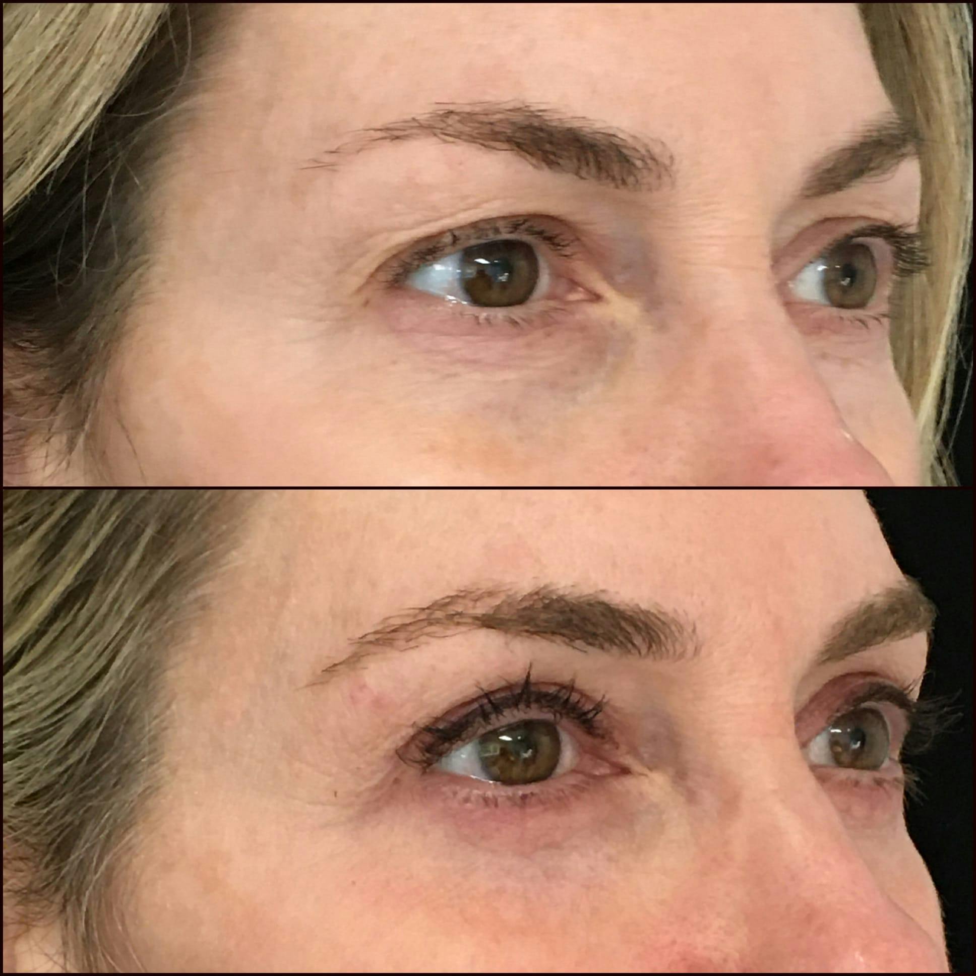 Lower Blepharoplasty Before & After Gallery - Patient 53591876 - Image 2