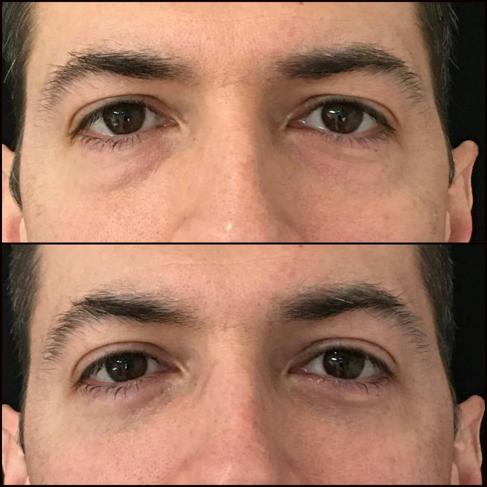 Lower Blepharoplasty Before & After Gallery - Patient 53591877 - Image 1
