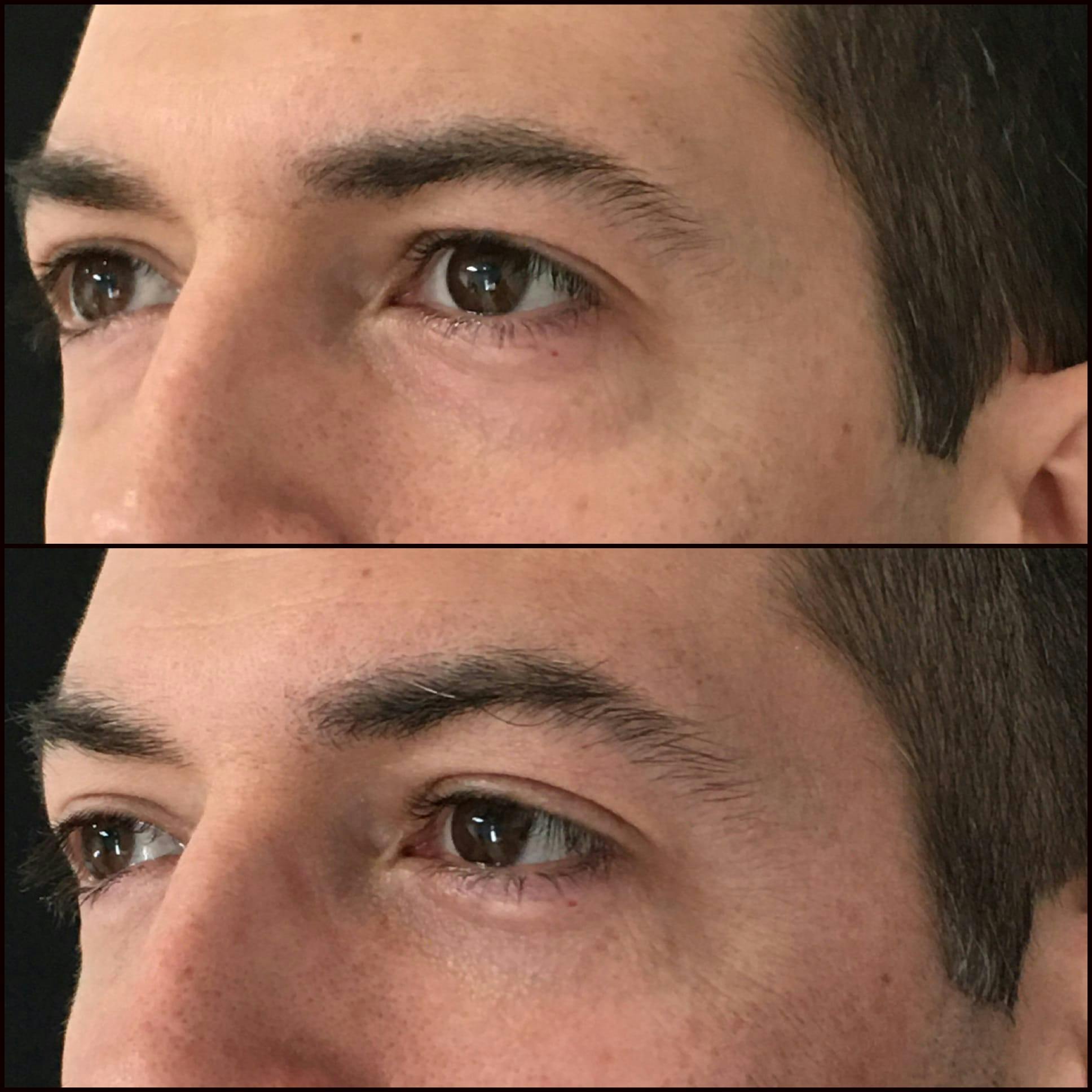 Lower Blepharoplasty Before & After Gallery - Patient 53591877 - Image 2