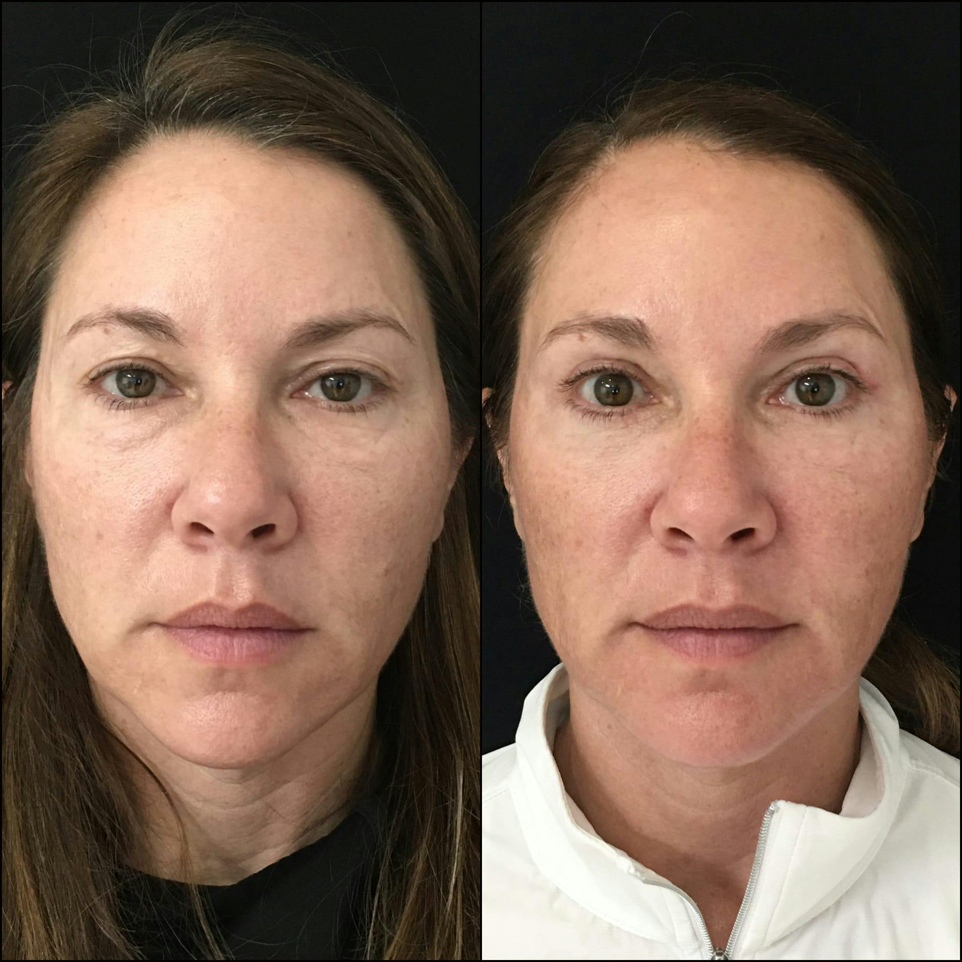 Lower Blepharoplasty Before & After Gallery - Patient 53591878 - Image 1