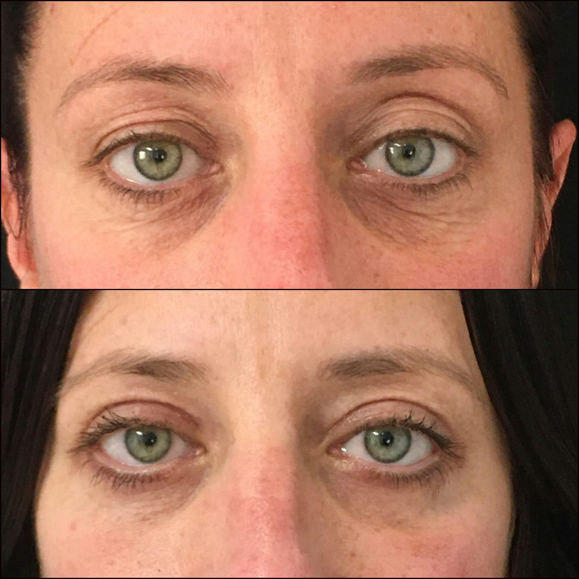 Lower Blepharoplasty Before & After Gallery - Patient 53591880 - Image 1
