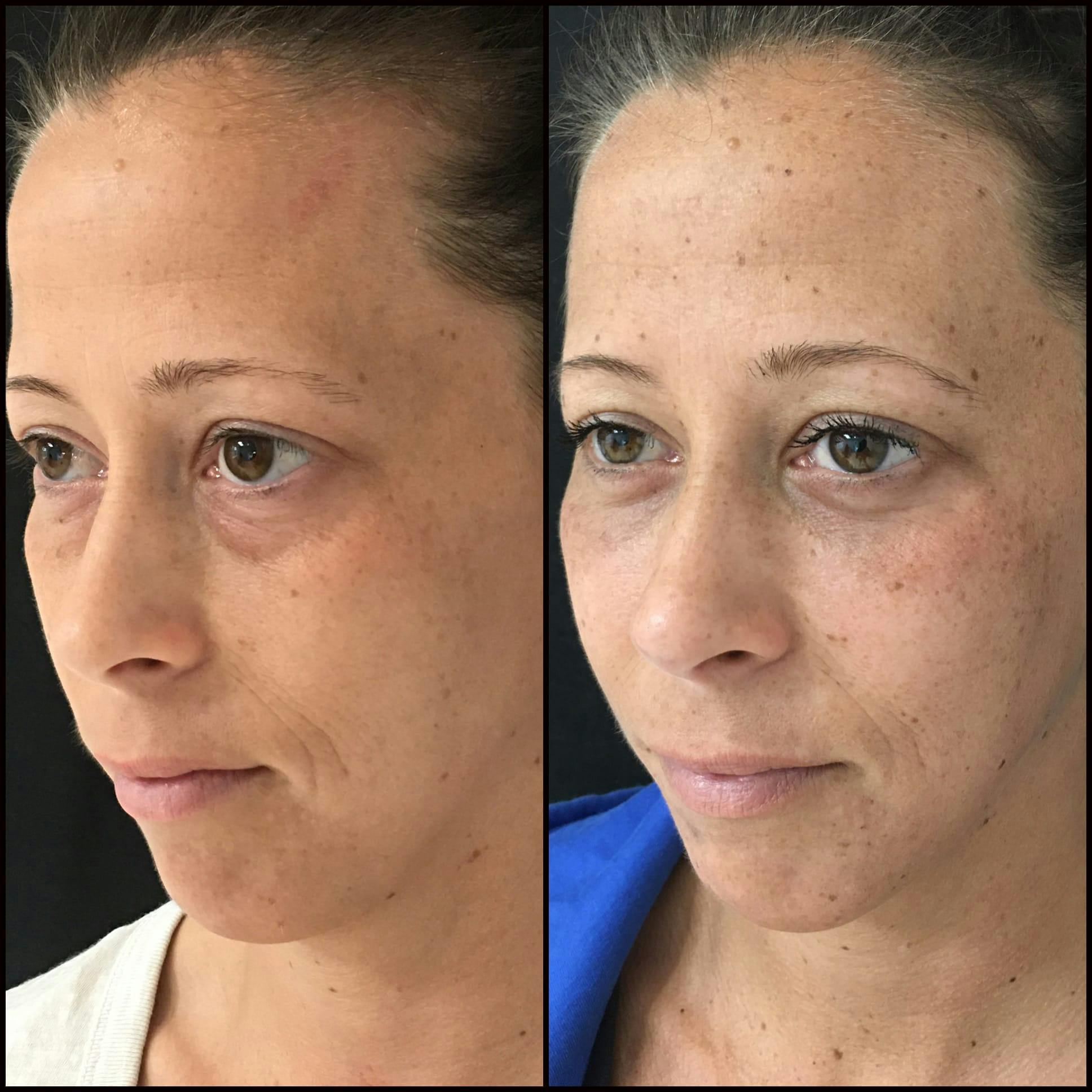 Lower Blepharoplasty Before & After Gallery - Patient 53591881 - Image 2