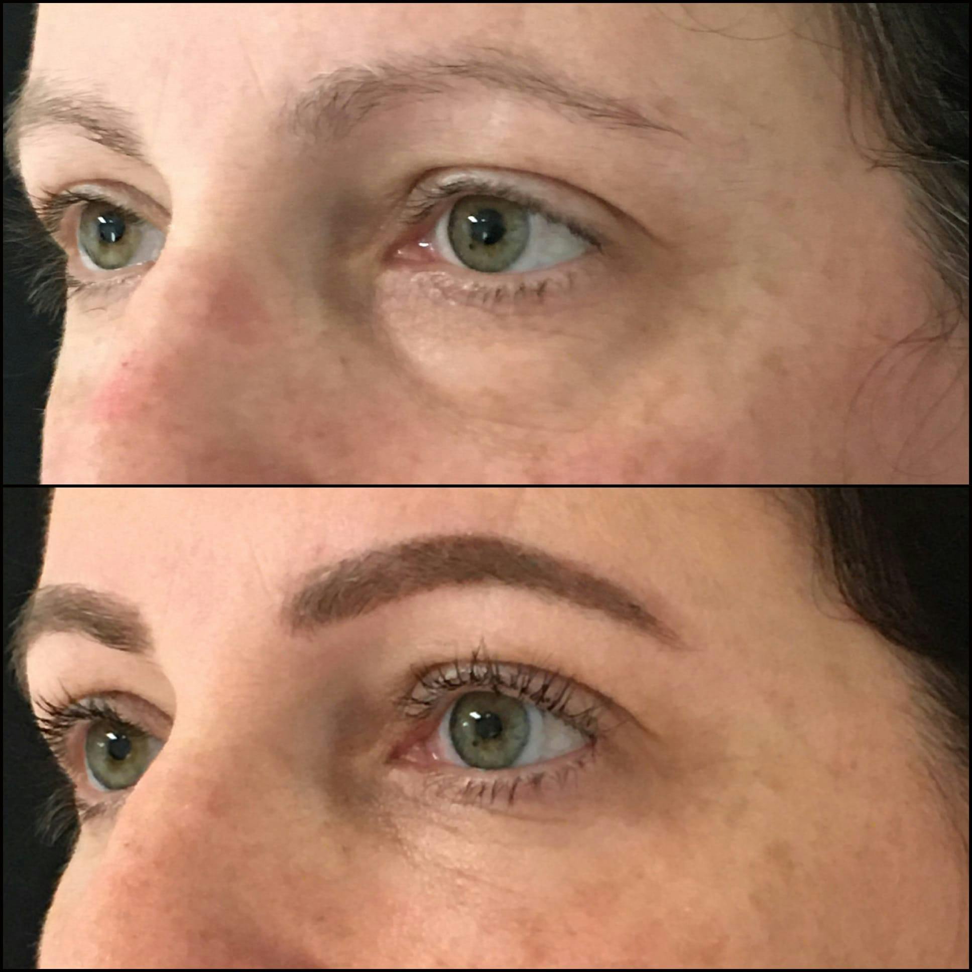 Lower Blepharoplasty Gallery - Patient 53591882 - Image 2