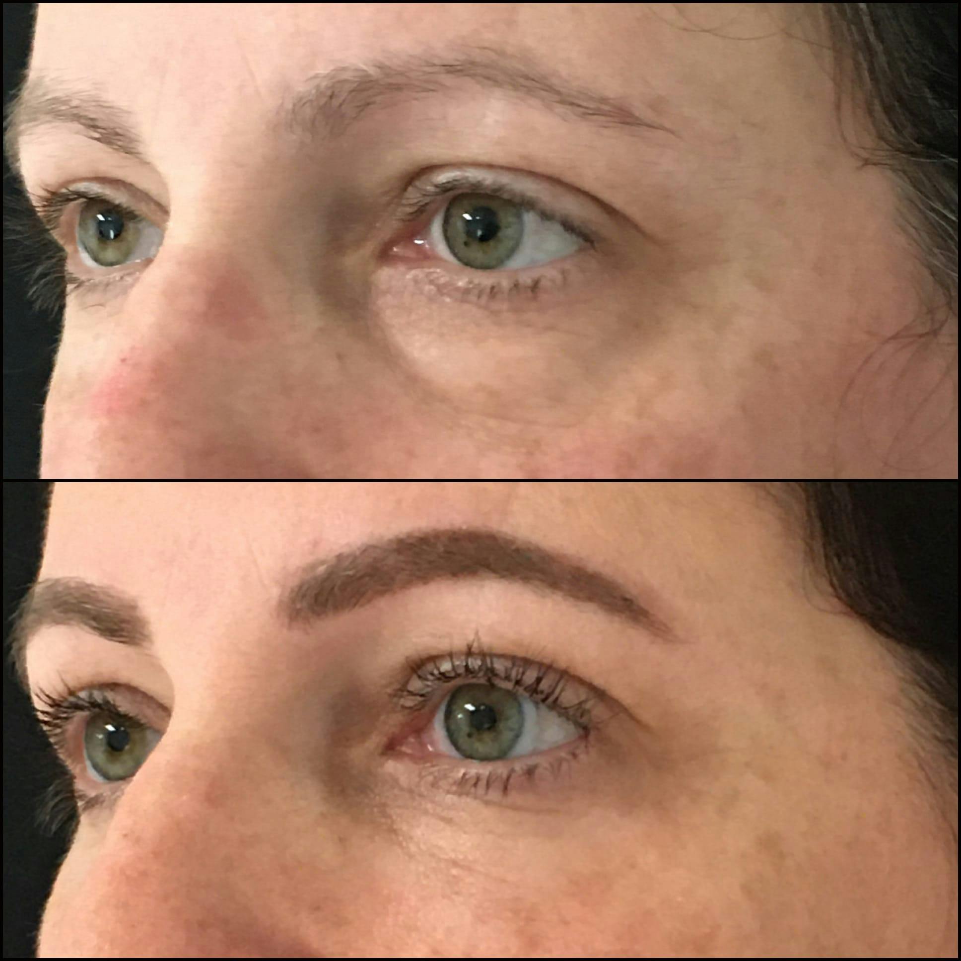 Lower Blepharoplasty Before & After Gallery - Patient 53591882 - Image 2