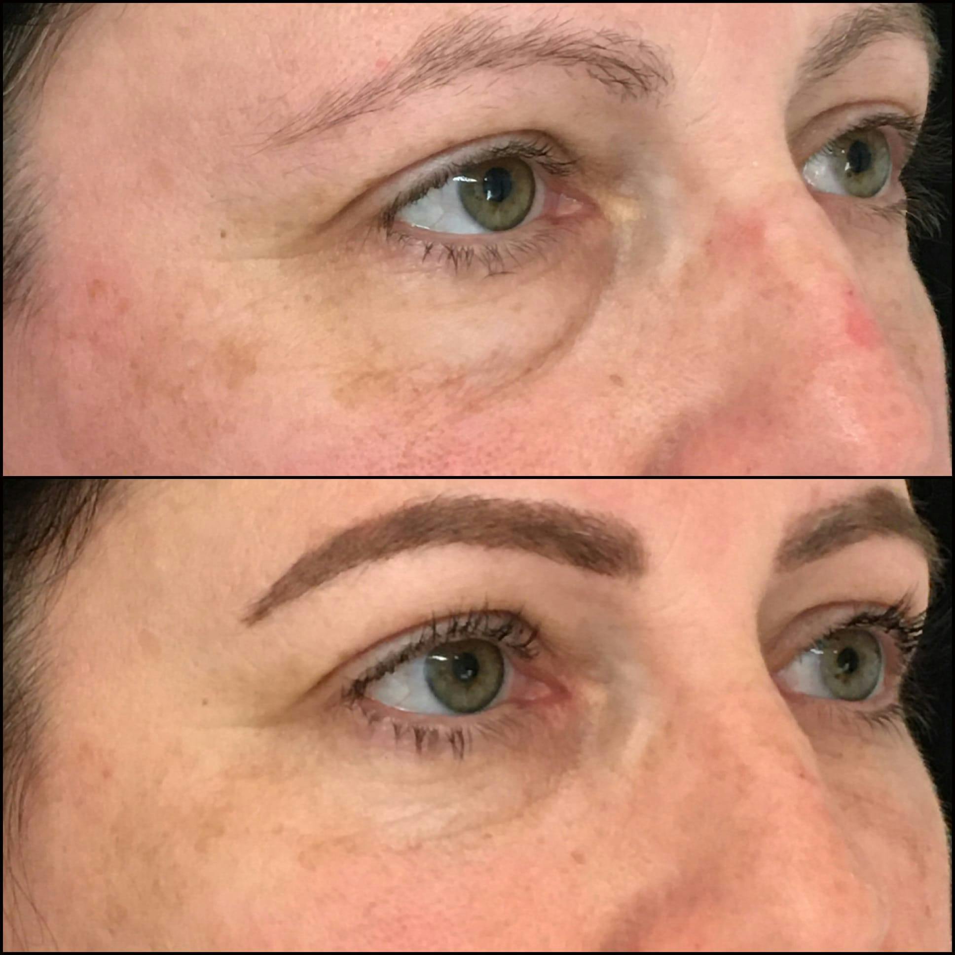 Lower Blepharoplasty Before & After Gallery - Patient 53591882 - Image 3