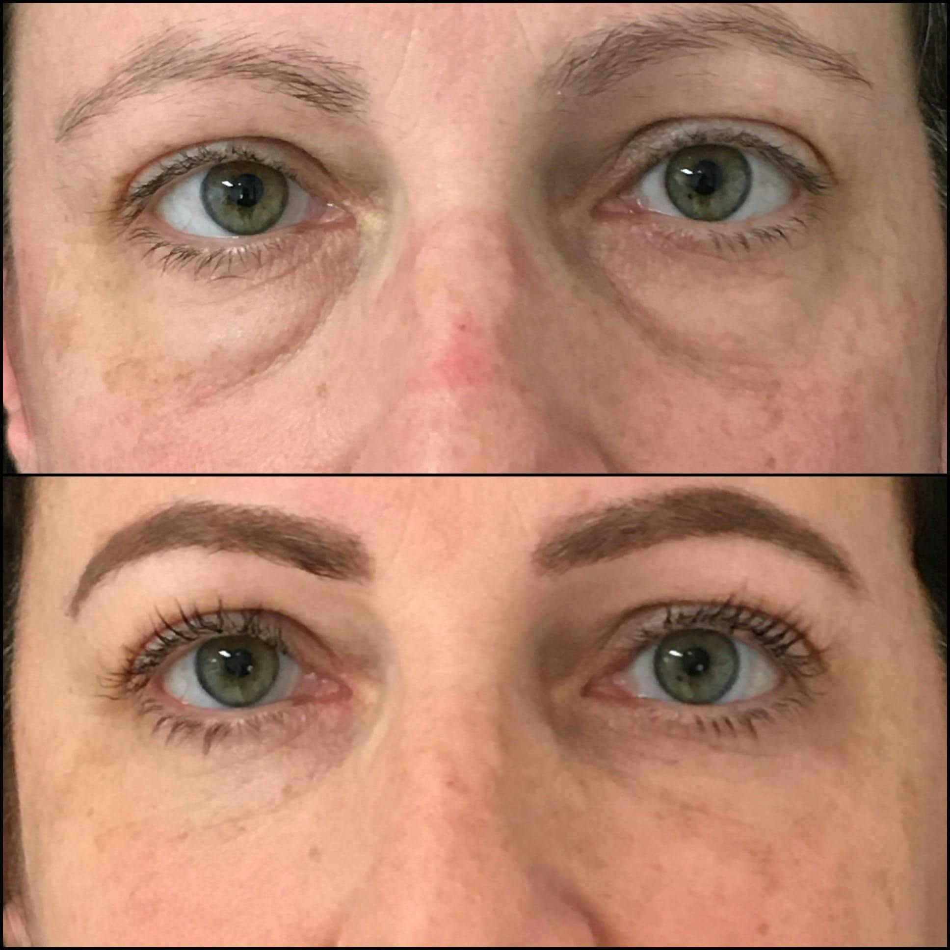 Lower Blepharoplasty Before & After Gallery - Patient 53591882 - Image 1