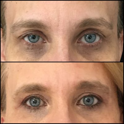 Ptosis Repair Before & After Gallery - Patient 53591897 - Image 1