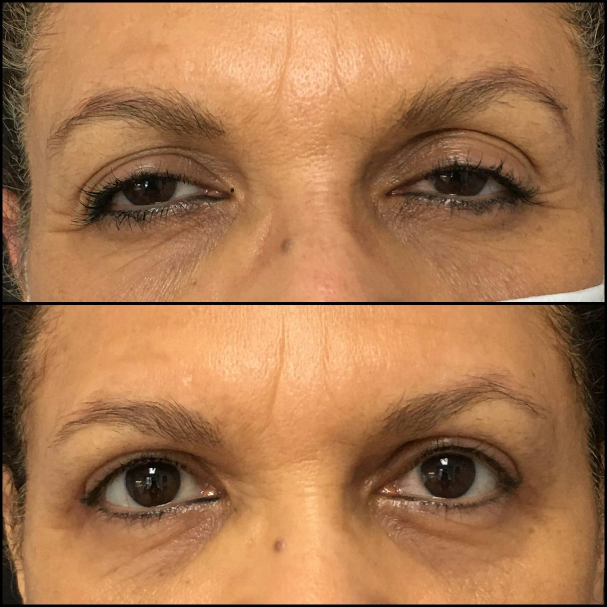 Ptosis Repair Before & After Gallery - Patient 53591898 - Image 1