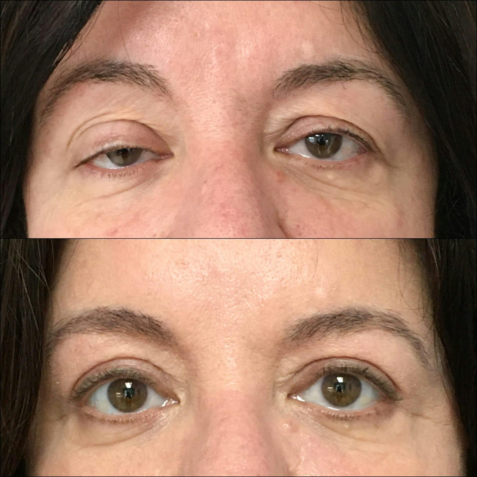 Ptosis Repair Before & After Gallery - Patient 53591899 - Image 1