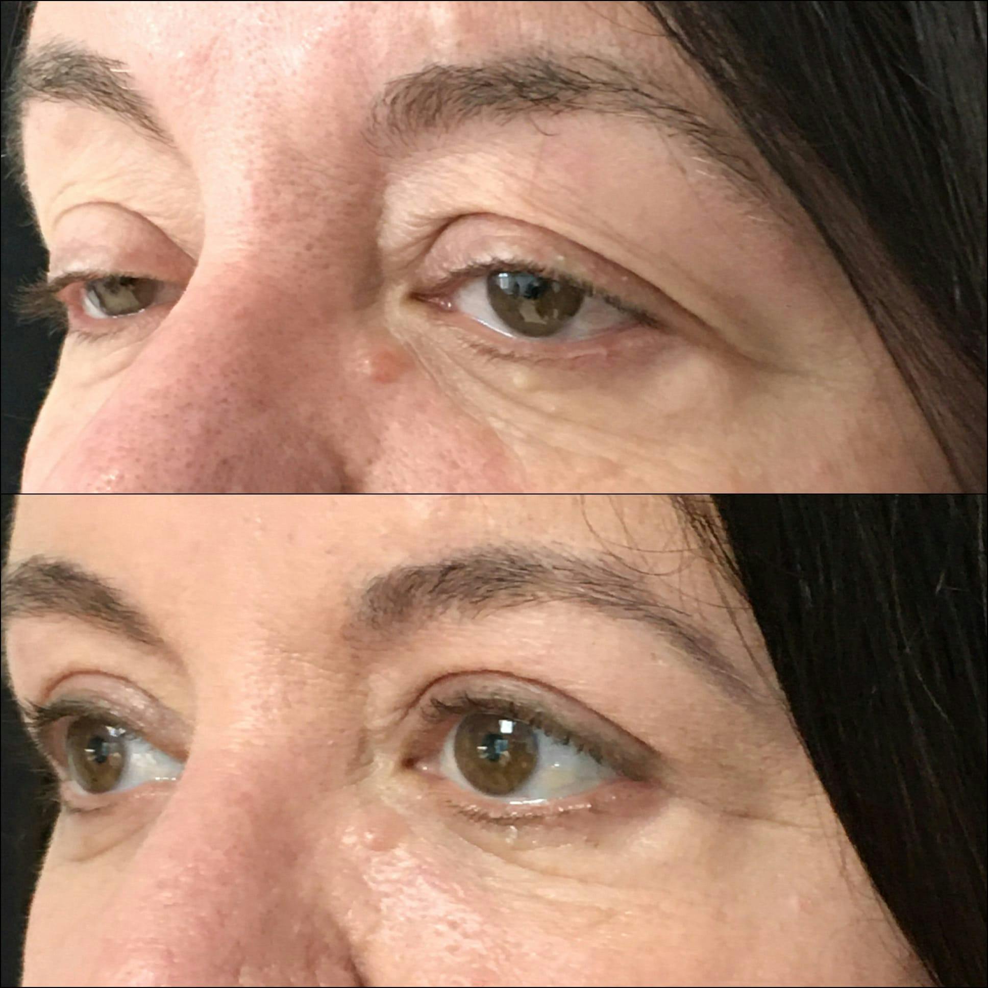 Ptosis Repair Before & After Gallery - Patient 53591899 - Image 2