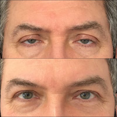 Ptosis Repair Before & After Gallery - Patient 53591900 - Image 1