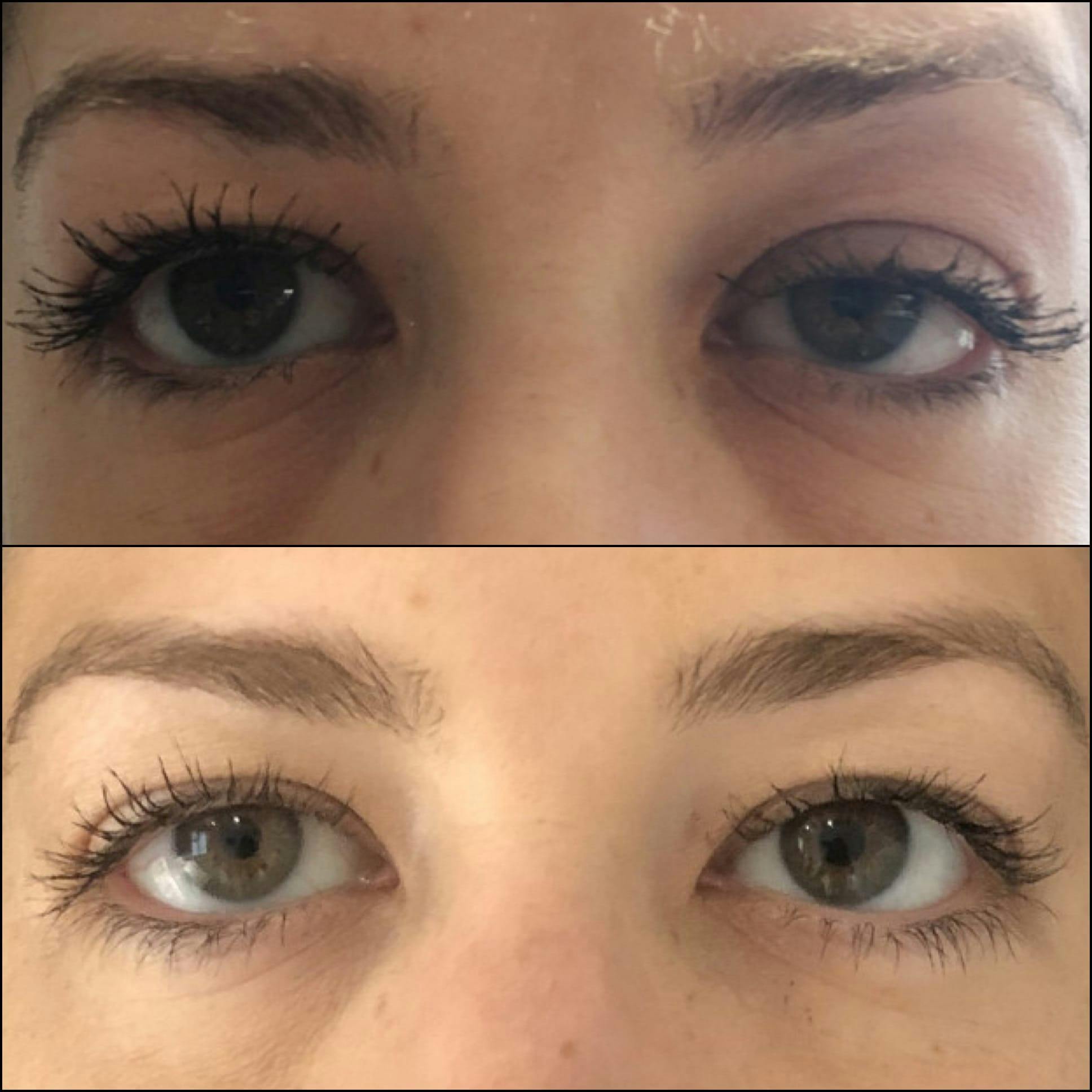 Ptosis Repair Before & After Gallery - Patient 53591901 - Image 1