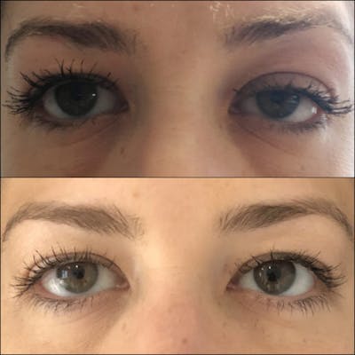 Ptosis Repair Before & After Gallery - Patient 53591901 - Image 1