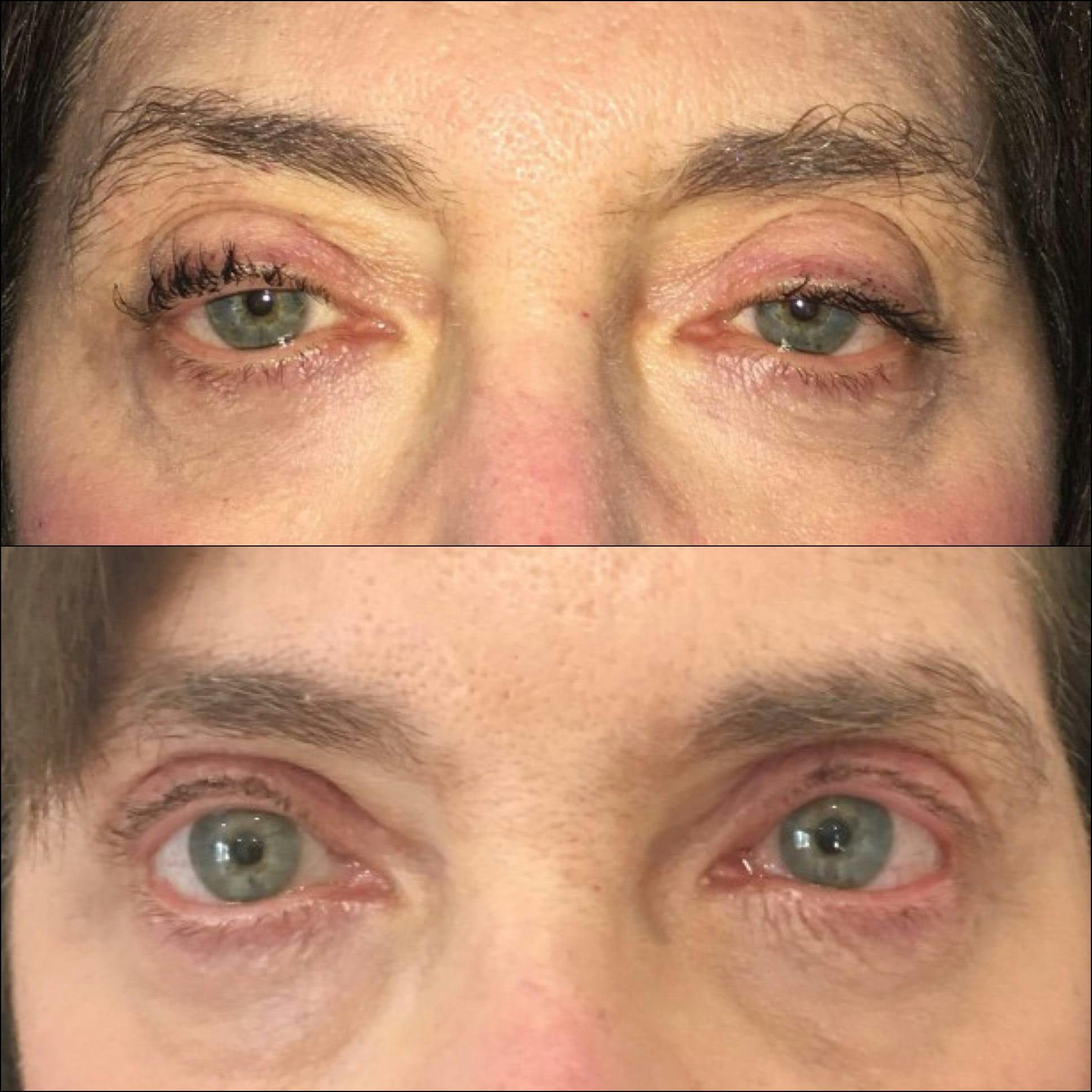 Ptosis Repair Before & After Gallery - Patient 53591902 - Image 1