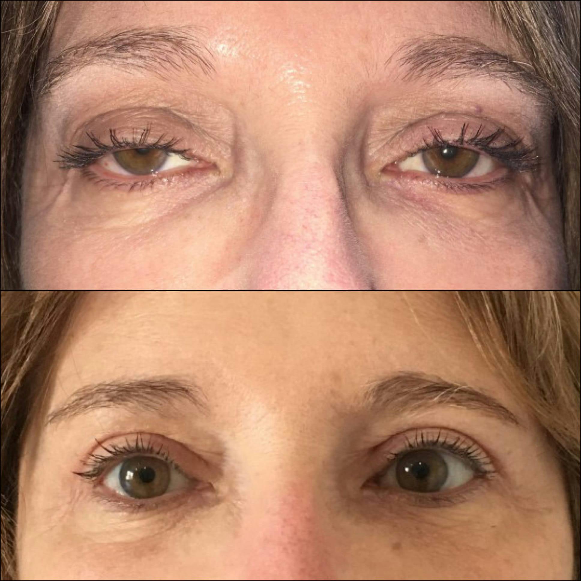 Ptosis Repair Before & After Gallery - Patient 53591903 - Image 1