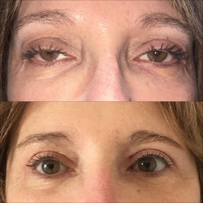 Ptosis Repair Before & After Gallery - Patient 53591903 - Image 1