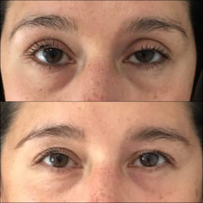 Ptosis Repair Before & After Gallery - Patient 53591904 - Image 1