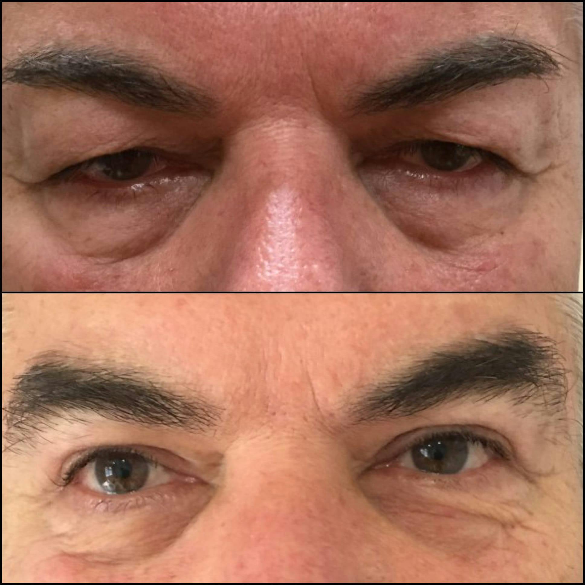 Ptosis Repair Before & After Gallery - Patient 53591905 - Image 1