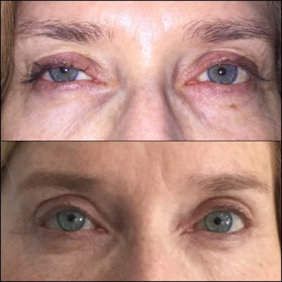 Ptosis Repair Before & After Gallery - Patient 53591906 - Image 1