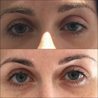 Ptosis Repair Before & After Gallery - Patient 53591907 - Image 1